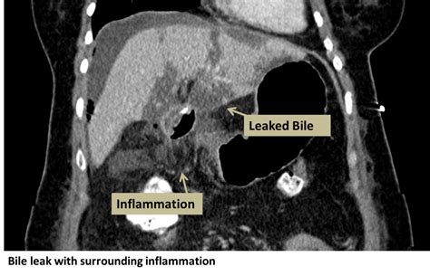 bile leakage symptoms|Bile Duct Leaks 